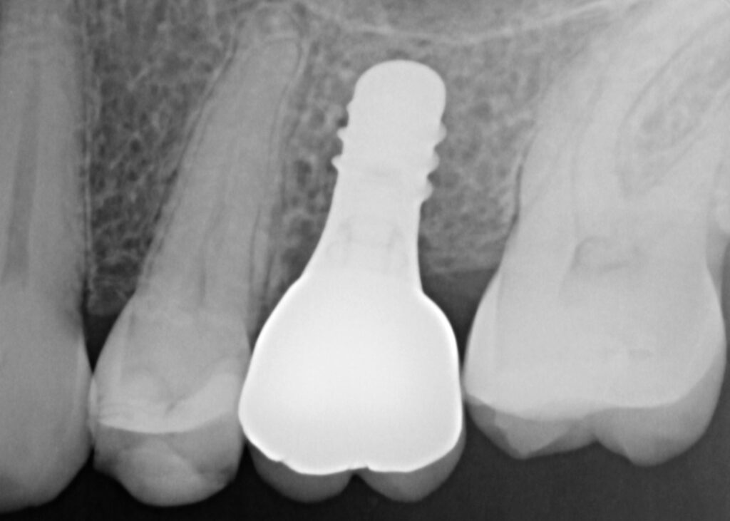 implant after