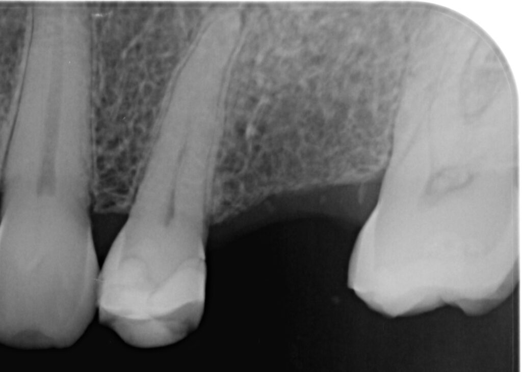 implant before