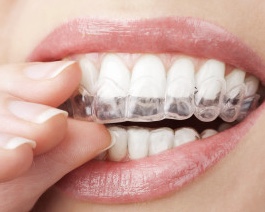 whitening trays on teeth
