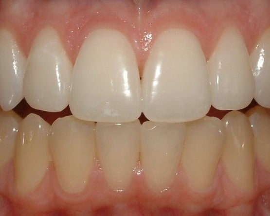 woolooware dentalwhitening